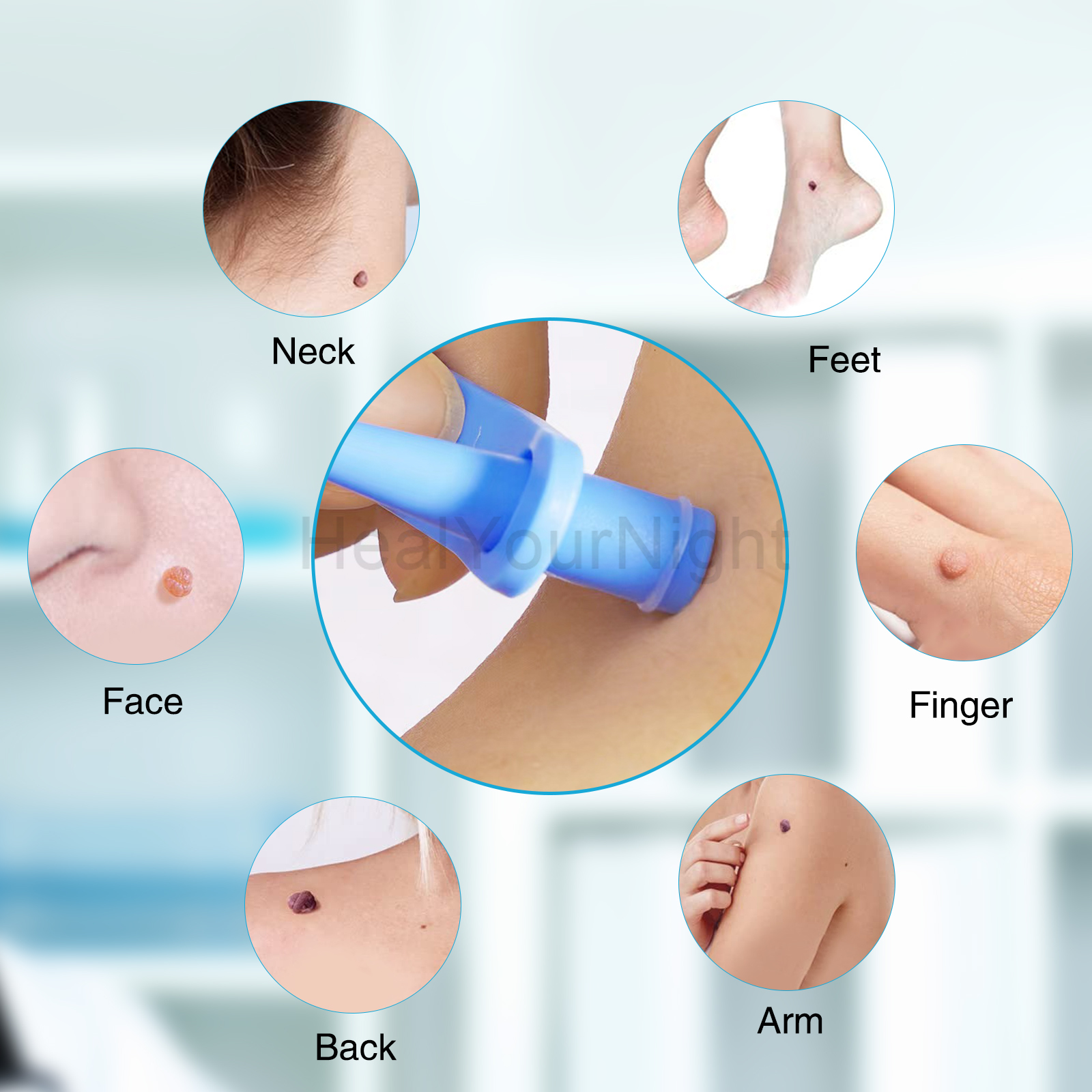 3-IN-1 Auto Skin Tag Removal K - Luxury Skincare Acne recensie en prijs