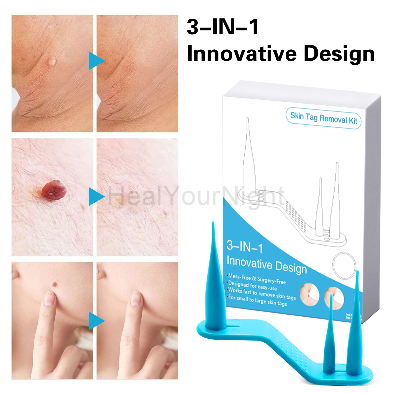 3-IN-1 Auto Skin Tag Removal K - Luxury Skincare Acne recensie en prijs