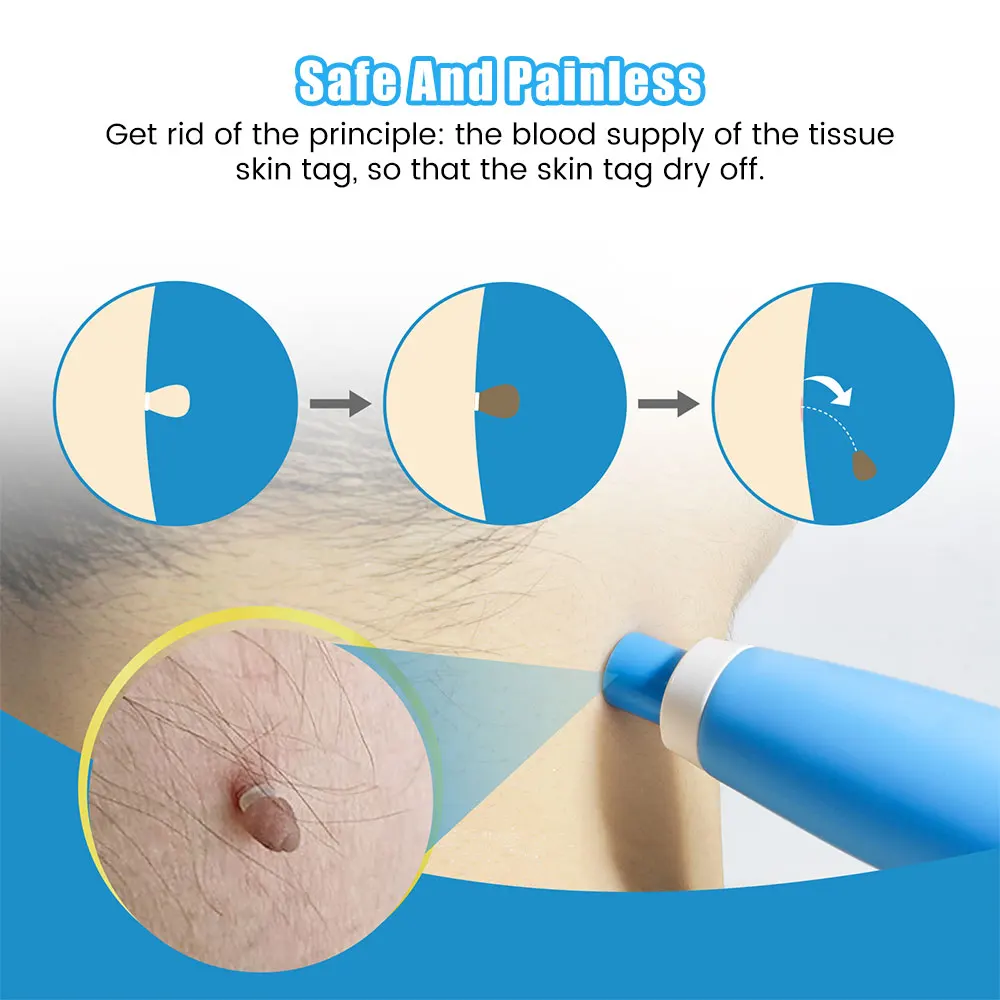 Auto Skin Tag Removal Tool Kit - Luxury Skincare Acne recensie en prijs