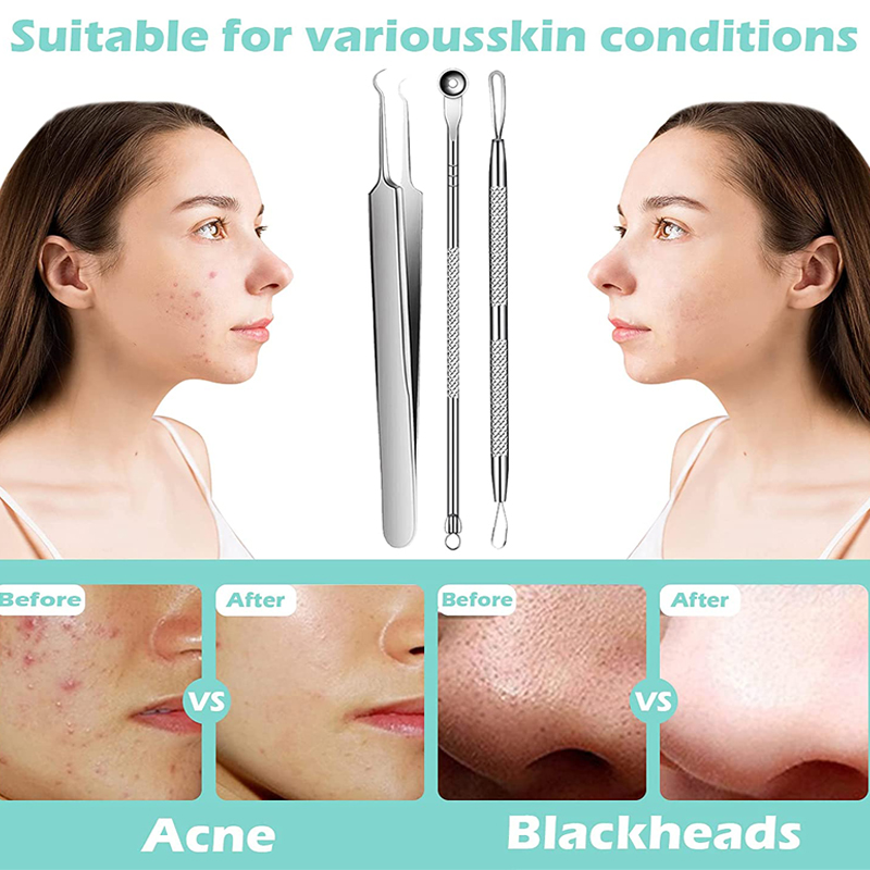 Acne Blackhead Removal Needles - Luxury Skincare Acne recensie en prijs
